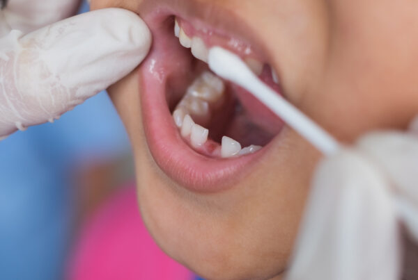 dentist applying fluoride treatment to child teeth with cotton swab