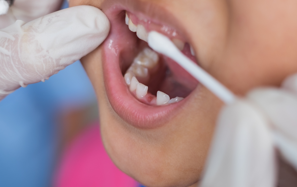 dentist applying fluoride treatment to child teeth with cotton swab